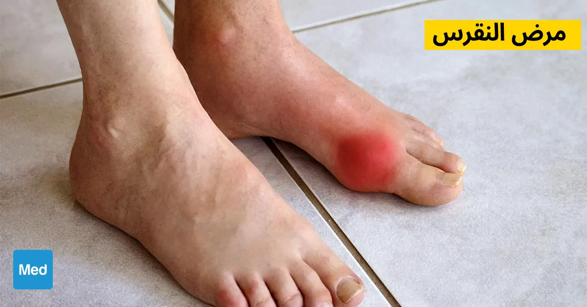 مرض النقرس - التشخيص والأسباب والعلاج